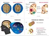 I en hjerne med fremskreden Alzheimer er mye av hjernevevet borte som følge av nedbryting av hjernecellene. Det fører til gradvis tap av minne og kognitive evner. Til slutt er tapet så stort at pasienten dør.
