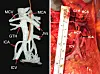 – Pasientenes karmønster i krøset er like unikt og gjenkjennbart som ansiktet deres, sier prosjektleder Dejan Ignjatovic. Bildene viser en 3D-modell laget på bakgrunn av CT-scan (t.v.), og faktisk kar som forsyner tarmen etter gjennomført operasjon (t.h.) på samme pasient. Fotokollasj: CTrue
