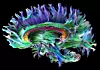 Nervebaner: En MRI-maskin med raske gradienter som den Siemens nettopp har lansert kan benytte en teknologi som kalles Diffusion Tensor Imaging og som f. eks. kan vise hvordan nervebanene i hjernen går. Foto: Siemens Siemens Healthineers